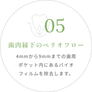 05｜歯肉縁下のペリオフロー｜4mmから9mmまでの歯周ポケット内にあるバイオフィルムを除去します。